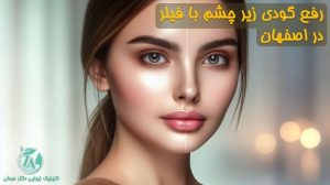 رفع گودی زیر چشم با فیلر در اصفهان