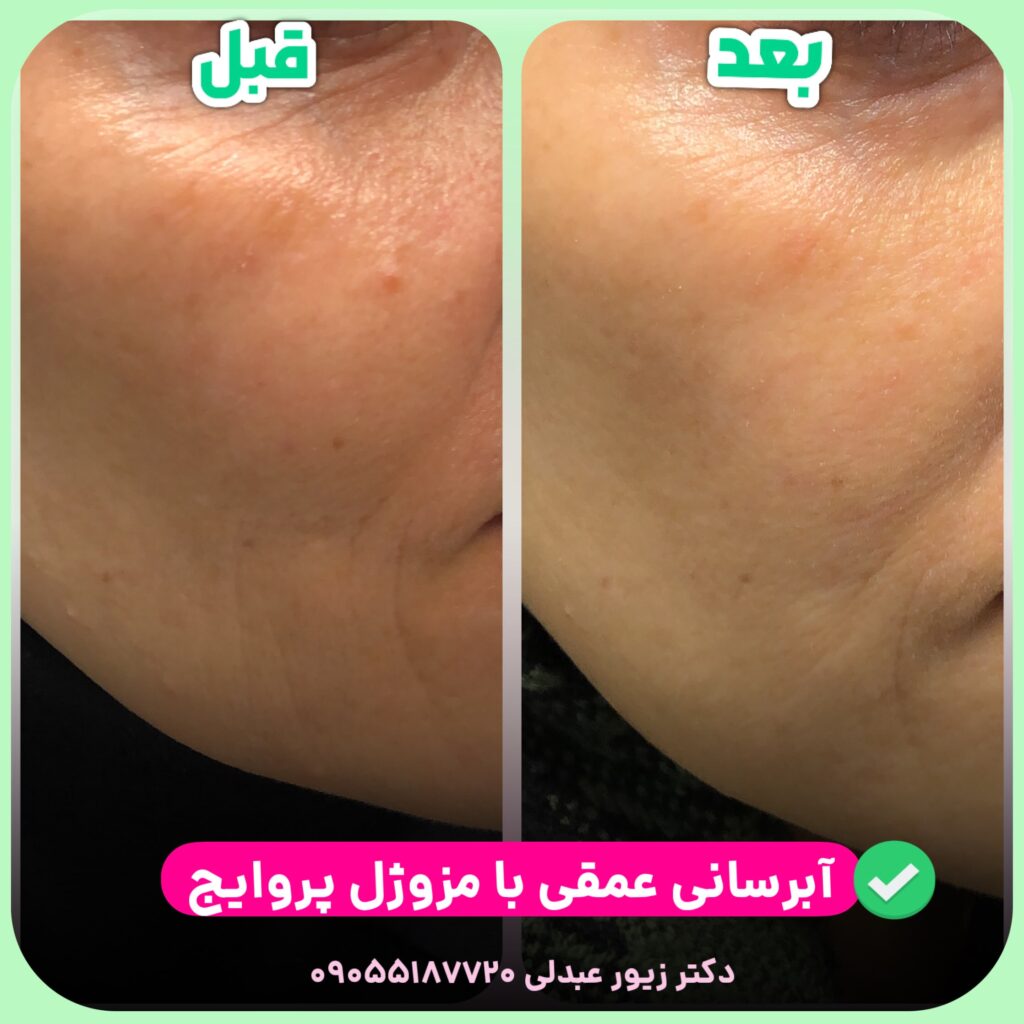 آبرسانی پوست با پروایج