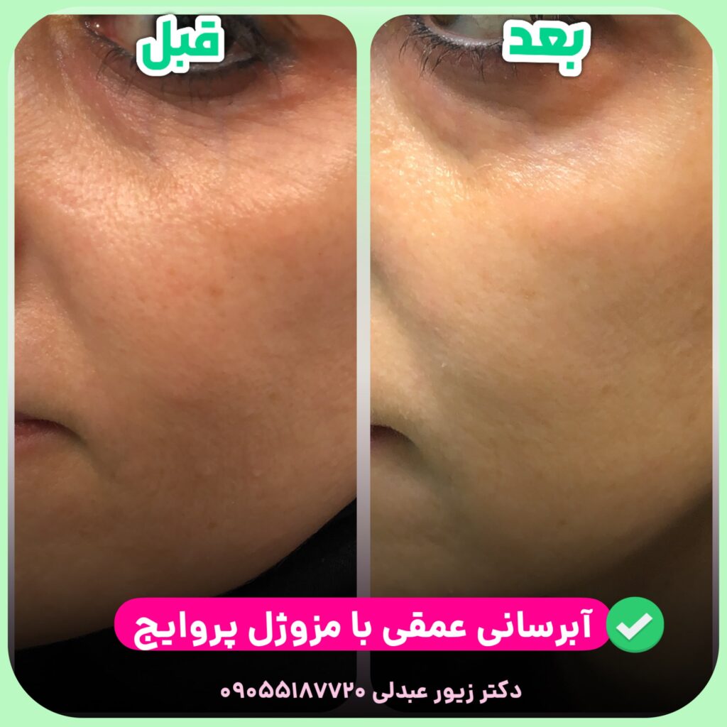 مزوژل پروایج چیست