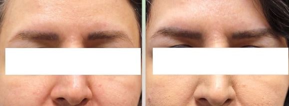 زیبایی با لیفت ابرو