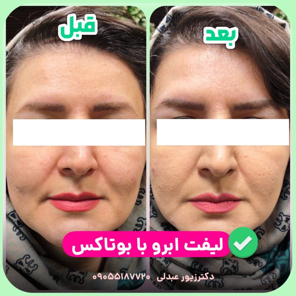 ماندگاری لیفت ابرو با بوتاکس