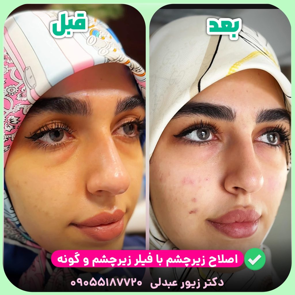 تزریق فیلر در اصفهان