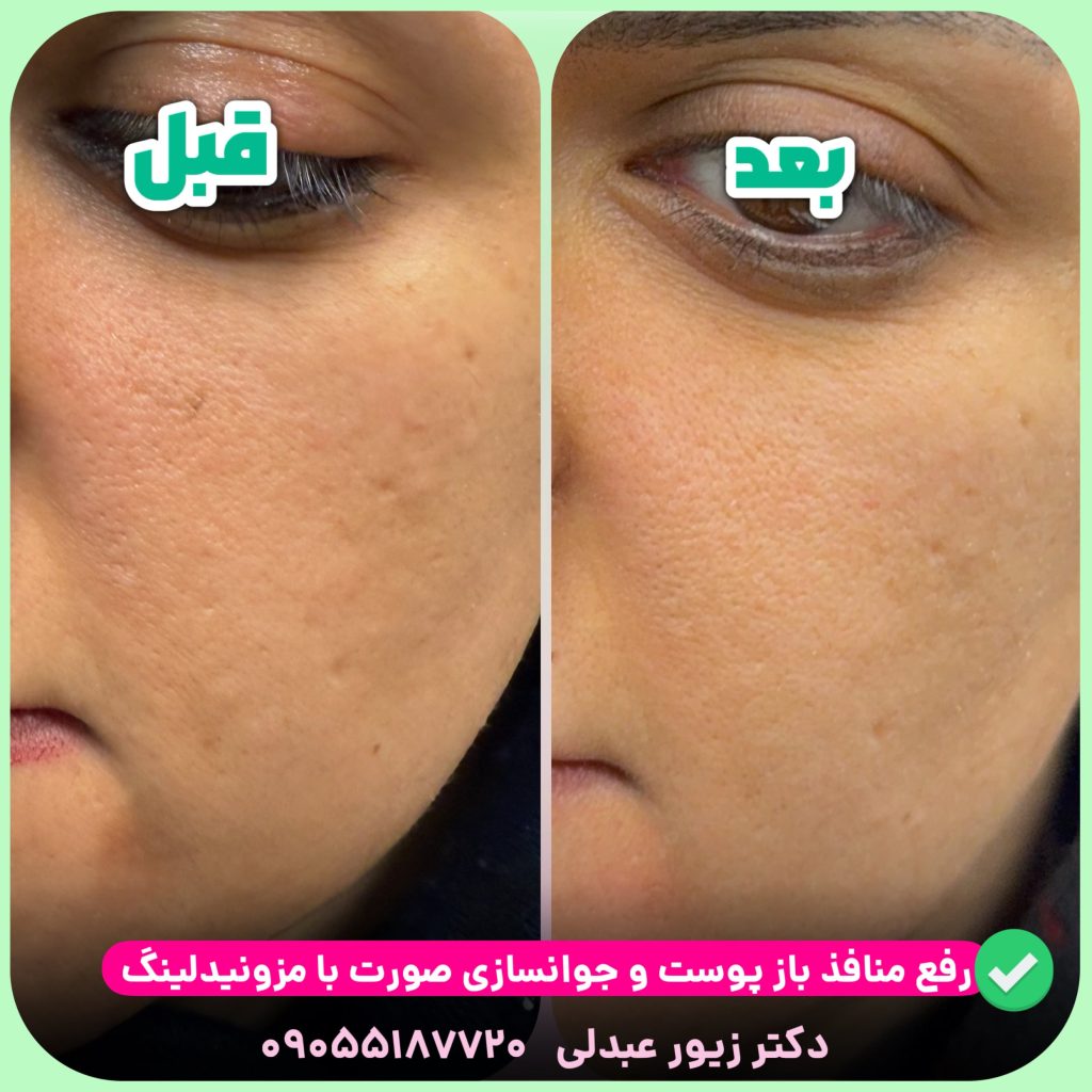 رفع منافذ باز با مزونیدلینگ