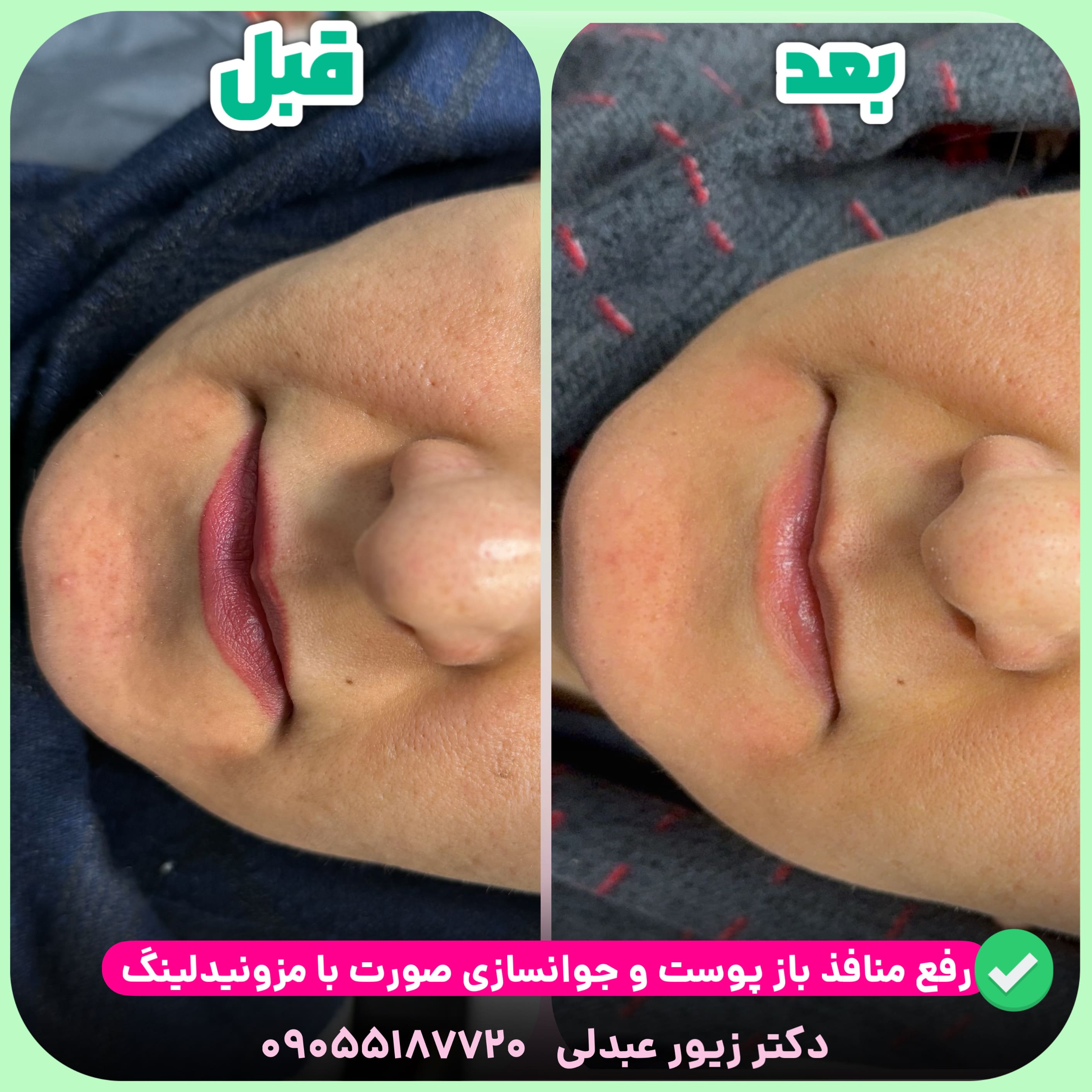 مزونیدلینگ صورت در اصفهان