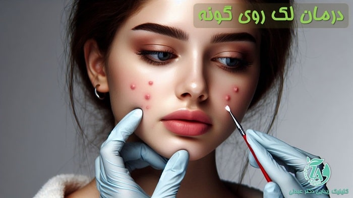 درمان لک روی گونه